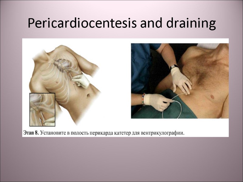 Pericardiocentesis and draining